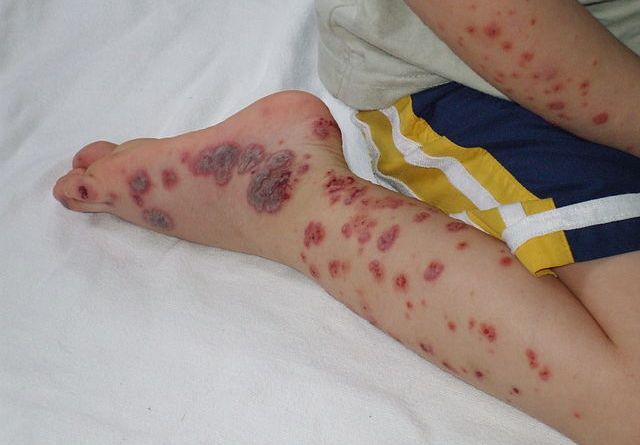 Kırım Kongo Kanamalı Ateşi