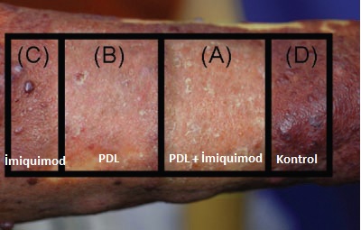 Nevus Flammeus, Porto Şarabı Lekesi, Port Wein Stain Lazer tedavisi