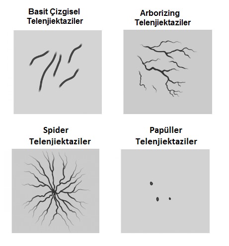 Bacakta Telenjektaziler