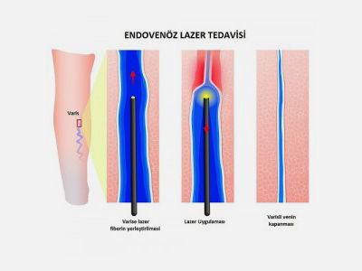 Varis İçerisinde Lazer Uygulaması, Endovenöz Lazer Tedavisi (EVLA)