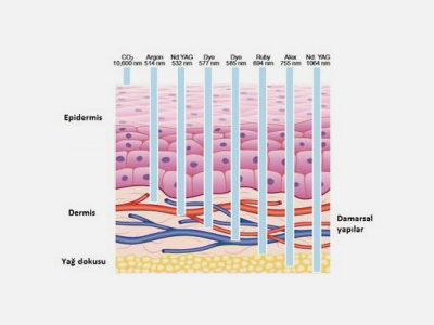 Küçük çaplı varisler, Kılcal damarlar, Damar çatlaması, Telenjektazilerde Lazer Tedavileri