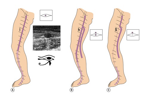 Ayaklarda Venöz Yetmezlikte, Varislerde ve Telenjektazilerde Ultrasound ve Doppler