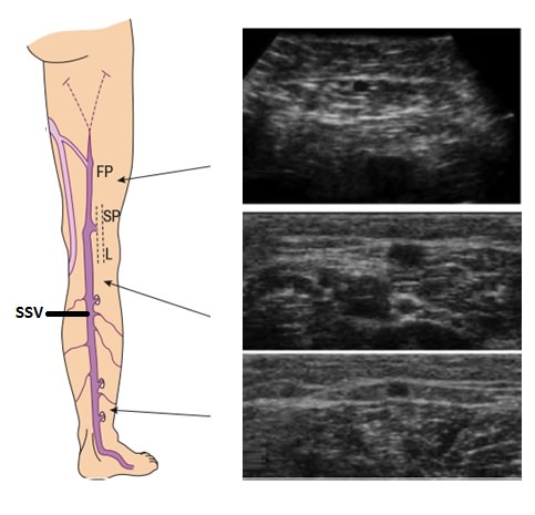 Ayaklarda Venöz Yetmezlikte, Varislerde ve Telenjektazilerde Ultrasound ve Doppler