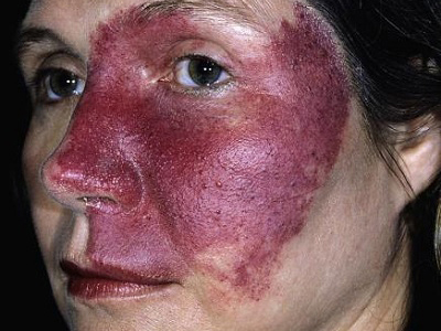 Damarsal Doğum Lekesi, Nevus Flammeus, Porto Şarabı Lekesi