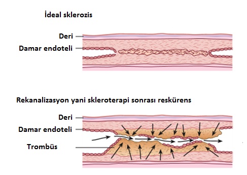 rekurens