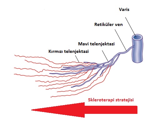 sklerotedavi yontem 03