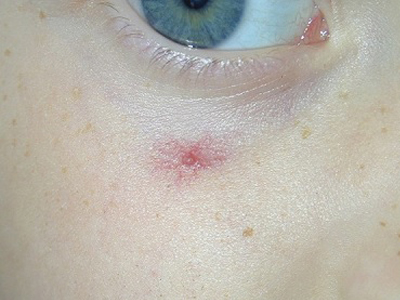 Spider Angioma, Örümcek Damarları, Örümcek Dmarsal ben