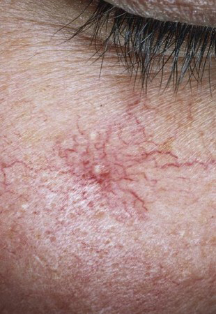 Spider Angioma (Örümcek Damarsal Ben)