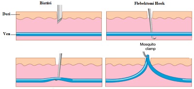 Varislerde Cerrahi Tedavi (Flebektomi)