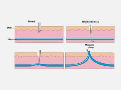 Varislerde Cerrahi Tedavi (Flebektomi)
