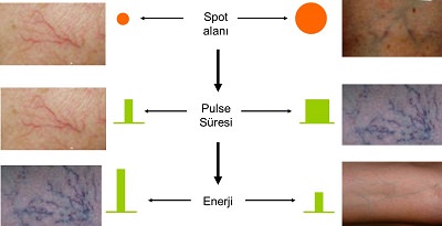 Doğuştan ya da Sonradan Gelişen Damarsal Hastalıklarda Lazer Tedavisi