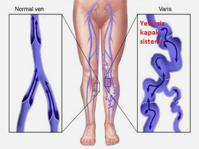 Bacaklarda Venöz Yetmezlik, klinik sınıflama