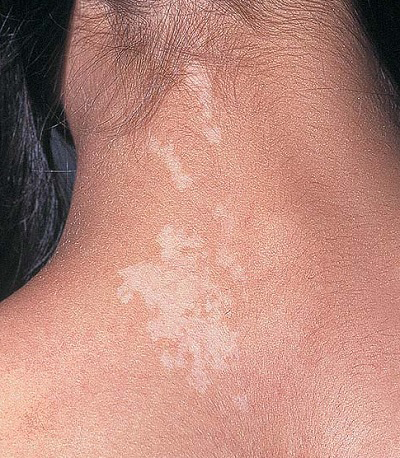 Depigmente Nevus (Akromik Nevüs)