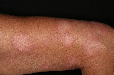 Pityriasis Alba