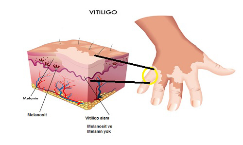 Vitiligo'da Fototerapi ve 308 Nm Dar Bant UVB Tedavisi