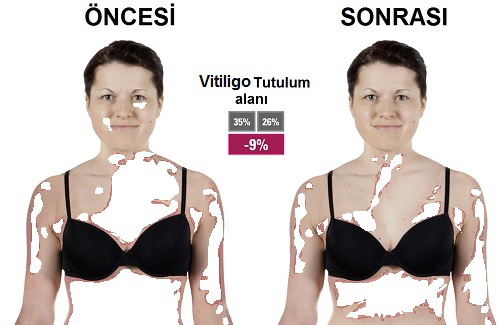 Vitiligo'da Fototerapi ve 308 Nm Dar Bant UVB Tedavisi