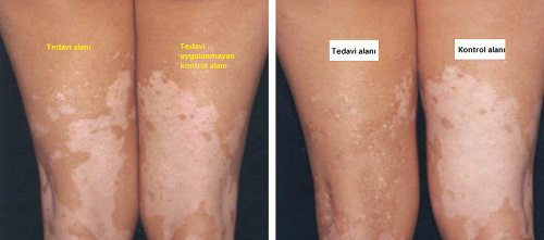 Vitiligo'da Fototerapi ve 308 Nm Dar Bant UVB Tedavisi