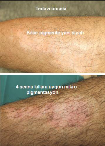 Vitiligo'da Fototerapi ve 308 Nm Dar Bant UVB Tedavisi