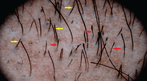 Trikoskopi (Trichoscopy)