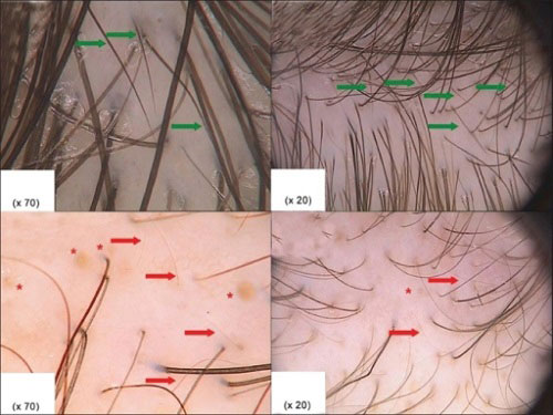 Trikoskopi (Trichoscopy)