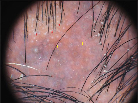 Trikoskopi (Trichoscopy)