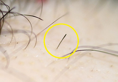 Alopesi