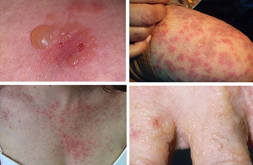 Dermatitis Herpetiformis (Duhring Hastalığı)