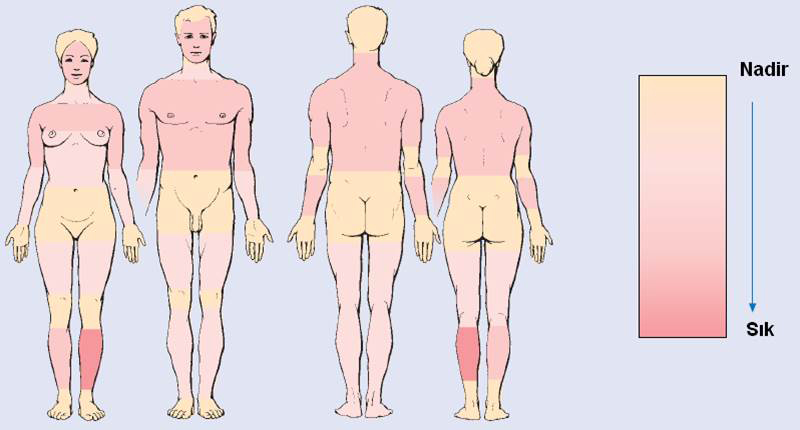 Maling Melanoma'nın Dağılım Lokasyonları