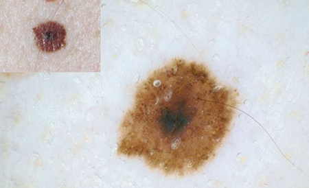 Kombine Nevus