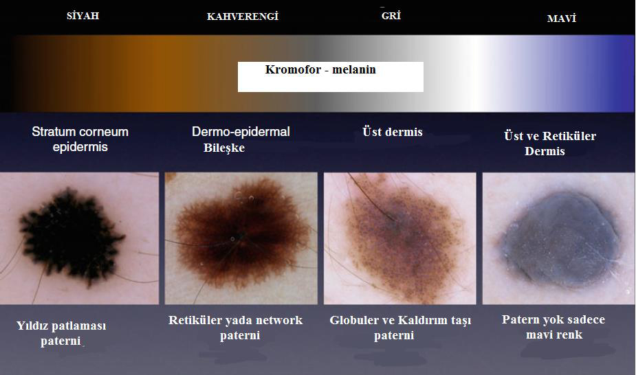 Melanositik Nevüslerin Dermatoskopik Sınıflandırılması