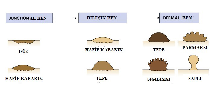 Melanositik Nevüslerin Klinik Tipleri