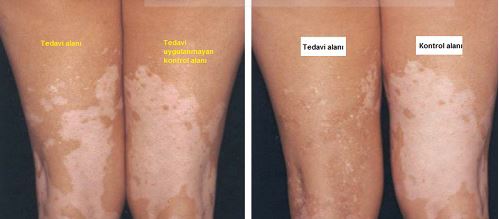 Vitiligo Tedavisi, Fototerapi,308 Nm Dar Bant UVB Tedavisi