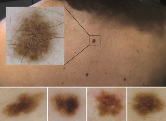 dermoskopi-18.jpg