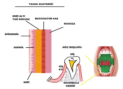 dimpleplasty_yanak_gamze_uygulamasi.jpg
