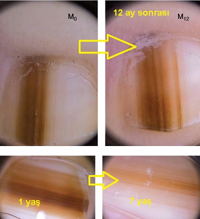 dogumsal-tirnak-pigmente-nevus-dermoskopi-takip.jpg