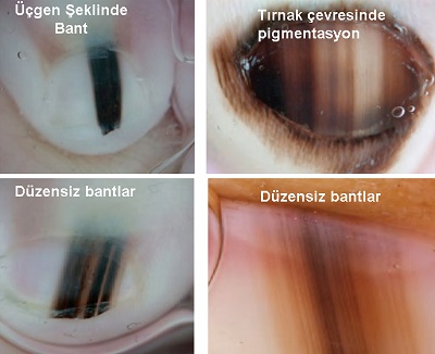 dogumsal-tirnak-pigmente-nevus-dermoskopi.jpg