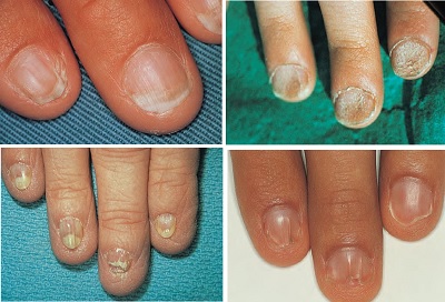 ektodermal-displazi-ve-tirnak.jpg