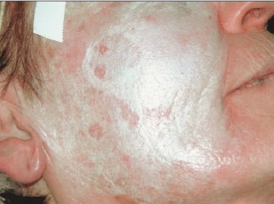 fenol-kimyasal-peeling-10.jpg