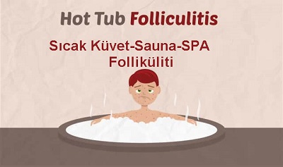 SPA Folliküliti, Sıcak Banyo Küveti Folliküliti, Hot Tube