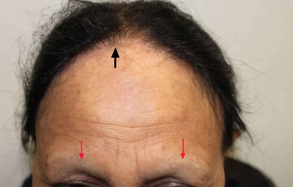 Frontal Fibrosing Alopesi Alopecia