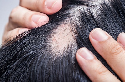 Alopesi Areata Tedavisinde Fraksiyonel CO2 Lazer 