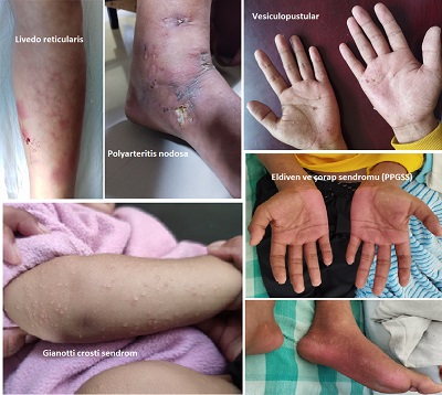 Dermatolojide Parvovirüslerin Neden Olduğu Hastalıklar