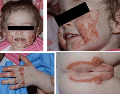 genetik-cinko-eksikligi-akrodermatitis-enteropatika.jpg