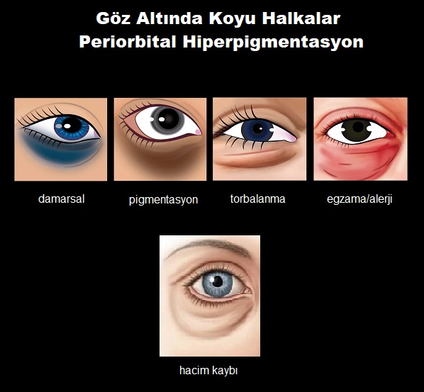 goz_alti_koyu_halkalari_periorbital_hiperpigmentasyon.jpg
