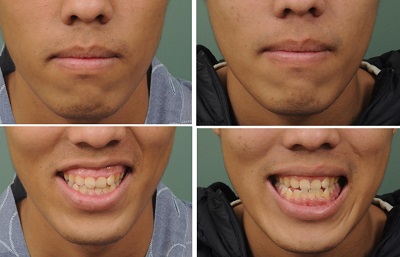Gummy Smile, Diş Eti Gülüşü, Diş Etlerinin Aşırı Görünmesi, Tedavisi, Botoks ve Otolog Yağ Enjeksiyonu