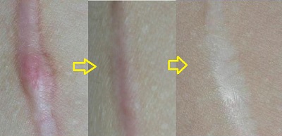 hipertrofik-skar-keloidfraksiyonel-co2-lazer-2.jpg