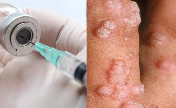 HPV, Siğil Virüsü, Kanser ve Aşı