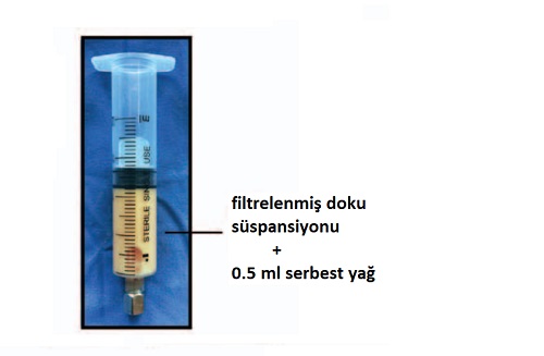 hucresel_tedavisvfadsc_jel_stromal_vaskuler_fraksiyon_yag_doku_kaynakli_kok_hucre_ciltyuz_genclestirme_4.jpg