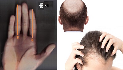 Androgenetic Alopecia ve Parmak Uzunluk İlişkisi 