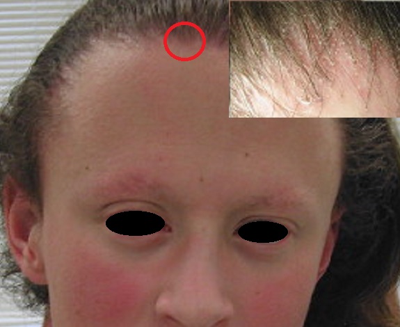 kas_kirpik_dokulmesi_Keratosis_foliklaris_spinulosa_decalvans.jpg